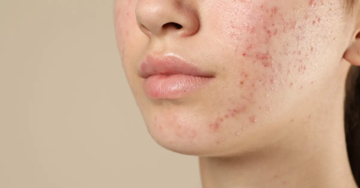 Κοπέλα όπου το πρόσωπό της έχει ακμή